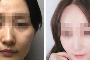 蚌埠立方醫(yī)療美容整形醫(yī)院王樹立整形價(jià)格表附埋線提升案例展示