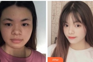 蚌埠立方醫(yī)療美容整形醫(yī)院徐靜整形價(jià)格表附埋線提升案例展示