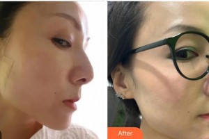 蚌埠華美整形美容門診部官赳駒整形價(jià)格表附埋線提升案例展示