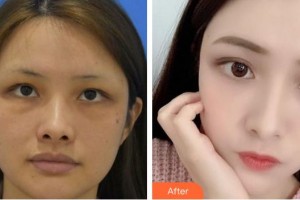 蚌埠華美整形美容門診部張瑞鵬整形價(jià)格表附埋線提升案例展示