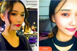 蚌埠韓美美萊醫(yī)療美容門診部陳澤整形價(jià)格表附熱瑪吉案例展示