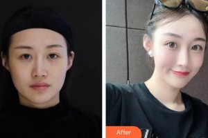 蚌埠韓美美萊醫(yī)療美容門診部鄭婕整形價(jià)格表附埋線提升案例展示