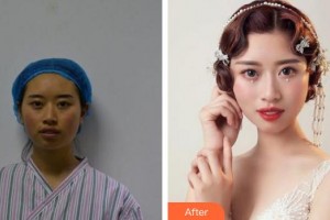 蚌埠韓美美萊醫(yī)療美容門診部張濤整形價(jià)格表附埋線提升案例展示