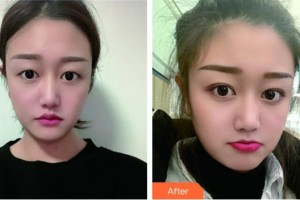 蚌埠市交通醫(yī)院醫(yī)療美容科湯學(xué)標(biāo)整形價(jià)格表附埋線雙眼皮案例展示