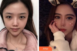 蚌埠康視眼科醫(yī)院鄒杰整形價(jià)格表附切開雙眼皮案例展示