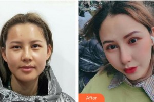 蚌埠康視眼科醫(yī)院高桂林整形價(jià)格表附眼部整形案例展示