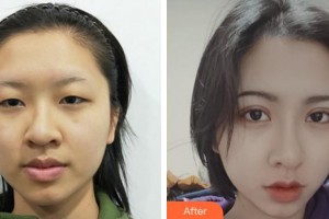 蚌埠康視眼科醫(yī)院汪蕾整形價(jià)格表附開內(nèi)眼角案例展示