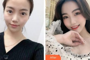 蚌埠康視眼科醫(yī)院葉蘭整形價格表附眼部綜合案例展示