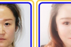 蚌埠康視眼科醫(yī)院趙瑩瑩整形價格表附眼部綜合案例展示