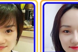 蚌埠市第一人民醫(yī)院整形外科田宇虹整形價格表附開外眼角案例展示