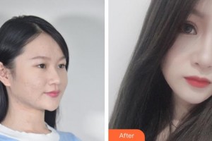 蚌埠懷遠(yuǎn)民康醫(yī)院方紅民整形價格表附眼部綜合案例展示