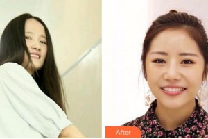 蚌埠三愛口腔門診部趙建榮整形價格表附牙齒隱形矯正案例展示