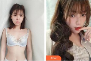 淮南麗人醫(yī)院整形美容科王海龍整形價格表附自體脂肪隆胸案例展示