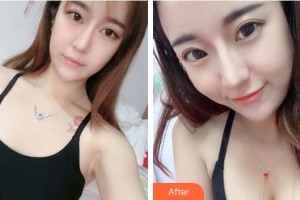 淮南瑞麗醫(yī)療美容門診部樸鐘洙整形價格表附自體脂肪隆胸案例展示