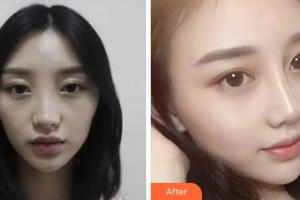 淮南麗顏醫(yī)療整形醫(yī)院呂永全整形價格表附鼻部綜合案例展示