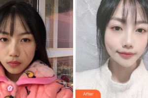 淮南市第一人民醫(yī)院燒傷整形科朱傳國整形價格表附微創(chuàng)疤痕修復(fù)案例展示