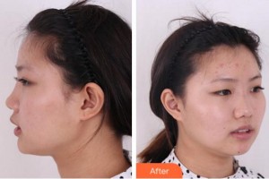 淮南金維整形醫(yī)院金輝家整形價格表附鼻部綜合案例展示