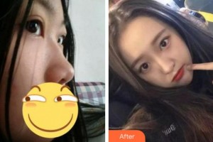 淮南凱婷美琪醫(yī)療美容醫(yī)院王清峰整形價格表附肋軟骨隆鼻案例展示