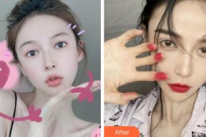 淮南麗顏醫(yī)療整形醫(yī)院劉建東整形價格表附耳軟骨復(fù)合隆鼻案例展示