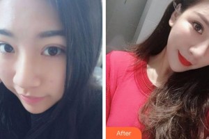 淮南麗顏醫(yī)療整形醫(yī)院張鵬鵬整形價格表附鼻部綜合案例展示