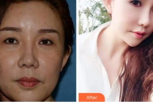 淮南澤明眼科醫(yī)院（原淮南東方醫(yī)院集團(tuán)眼科醫(yī)院）張玲整形價格表附外切祛眼袋案例展示