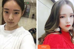 淮南華廈眼科醫(yī)院李波整形價格表附切開雙眼皮案例展示