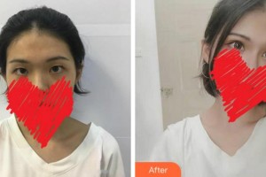 淮南澤明眼科醫(yī)院（原淮南東方醫(yī)院集團眼科醫(yī)院）陳蓓莉整形價格表附切開雙眼皮】案例展示