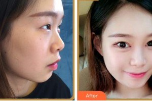 淮南澤明眼科醫(yī)院（原淮南東方醫(yī)院集團眼科醫(yī)院）劉杰整形價格表附眼部綜合案例展示