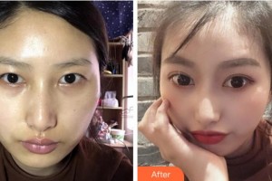 淮南澤明眼科醫(yī)院（原淮南東方醫(yī)院集團眼科醫(yī)院）李福芝整形價格表附切開雙眼皮案例展示