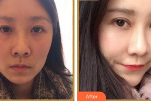 淮南晨光眼科醫(yī)院韓新繼整形價格表附眼部綜合案例展示