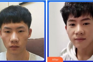 淮南澤明眼科醫(yī)院（原淮南東方醫(yī)院集團眼科醫(yī)院）趙小妹整形價格表附雙眼皮案例展示