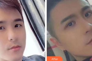 淮南晨光眼科醫(yī)院范敏整形價格表附眼部綜合案例展示