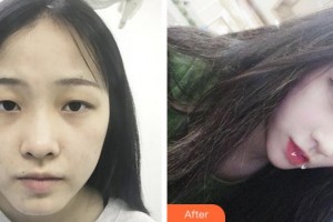 淮南晨光眼科醫(yī)院周本揚整形價格表附切開雙眼皮案例展示