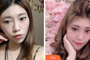 淮南晨光眼科醫(yī)院韓冬梅整形價格表附眼部綜合案例展示