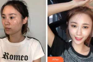 淮南東方醫(yī)院集團總醫(yī)院燒傷整形科蔣新安整形價格表附點陣激光案例展示