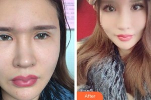 淮南鳳凰醫(yī)院眼科宮斌整形價格表附眼部修復案例展示