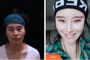 馬鞍山福華醫(yī)療美容醫(yī)院呂福華整形價格表附耳軟骨復合隆鼻案例展示