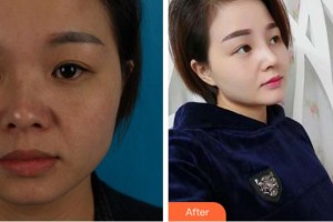 馬鞍山福華醫(yī)療美容醫(yī)院周曉晶整形價格表附耳軟骨復合隆鼻案例展示