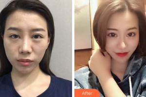 馬鞍山福華醫(yī)療美容醫(yī)院董帆整形價(jià)格表附鼻部綜合案例展示