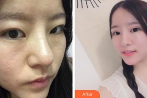 馬鞍山愛爾眼科醫(yī)院徐六三整形價(jià)格表附切開雙眼皮案例展示