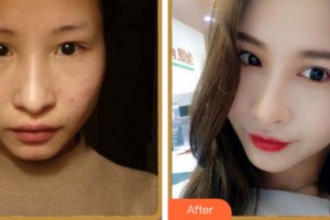 馬鞍山愛爾眼科醫(yī)院汪國飛整形價(jià)格表附眼部綜合案例展示