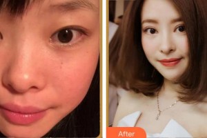 馬鞍山康視眼科醫(yī)院顧莉莉整形價(jià)格表附眼部綜合案例展示