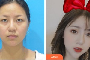 馬鞍山康視眼科醫(yī)院蔣平整形價(jià)格表附眼部綜合案例展示