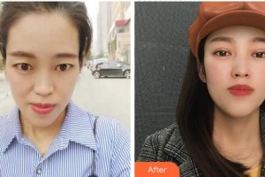 馬鞍山康視眼科醫(yī)院李華整形價(jià)格表附切開雙眼皮案例展示