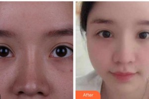 馬鞍山康視眼科醫(yī)院王林農(nóng)整形價(jià)格表附切開雙眼皮案例展示