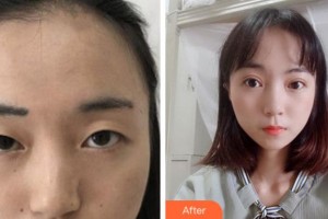 馬鞍山康視眼科醫(yī)院王育良整形價(jià)格表附切開雙眼皮案例展示