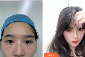 馬鞍山康視眼科醫(yī)院劉虎整形價(jià)格表附眼部修復(fù)案例展示