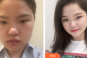 廣州軍美整形醫(yī)院顏玲整形價(jià)格表附隆鼻案例展示