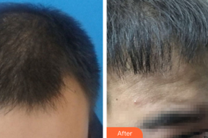 廣州中科美整形醫(yī)院姜衛(wèi)整形價(jià)格表附種植發(fā)際線案例展示