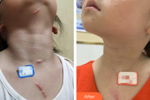 廣州膚康皮膚科醫(yī)院吳月志整形價(jià)格表附增生疤痕案例展示